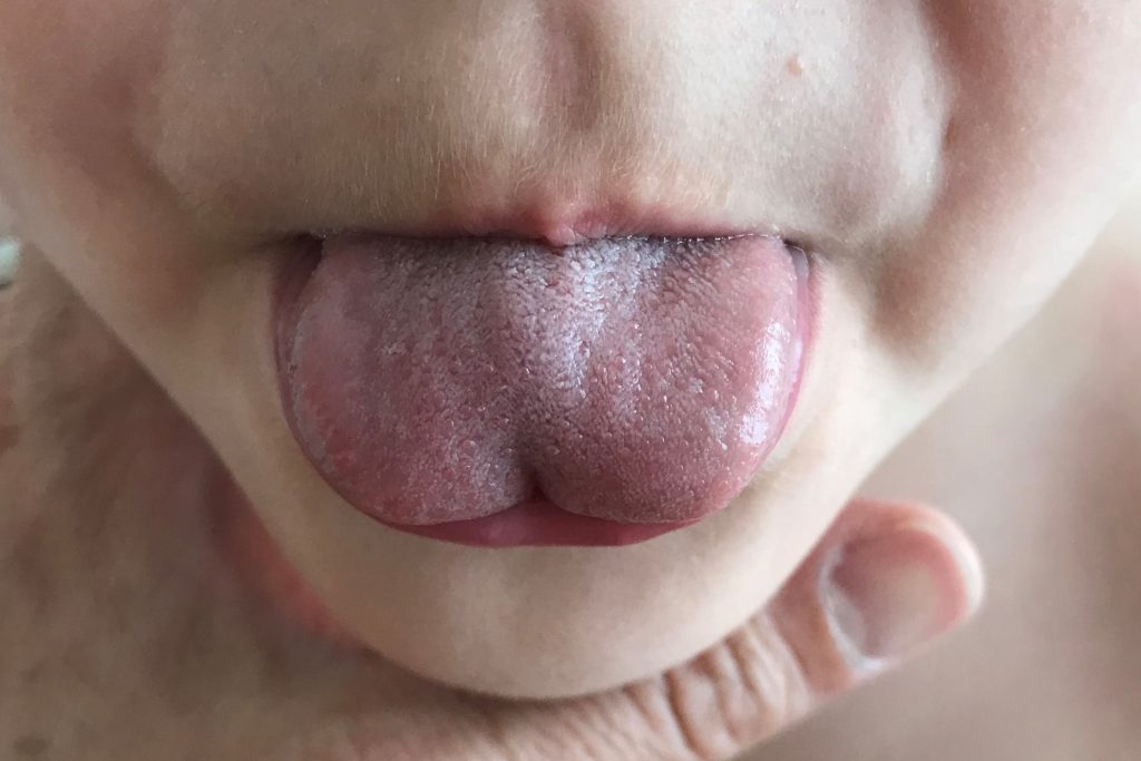Picture of tongue-tie
